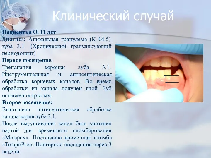 Клинический случай Пациентка О. 11 лет Диагноз: Апикальная гранулема (К 04.5)