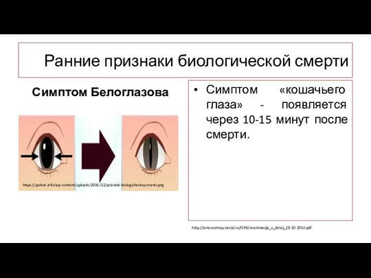 Ранние признаки биологической смерти Симптом Белоглазова Симптом «кошачьего глаза» - появляется