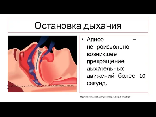 Остановка дыхания Апноэ – непроизвольно возникшее прекращение дыхательных движений более 10 секунд. http://amosovmop.narod.ru/OPK/reanimacija_u_detej_28-10-2014.pdf https://marketium.ru/wp-content/uploads/2016/03/c81e728d9d4c2f636f067f89cc14862c23.jpg