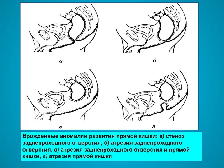 Врожденные аномалии развития прямой кишки: а) стеноз заднепроходного отверстия, б) атрезия