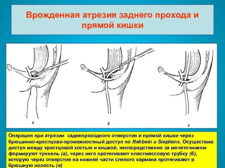 Врожденная атрезия заднего прохода и прямой кишки Операция при атрезии заднепроходного