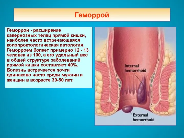 Геморрой Геморрой - расширение кавернозных телец прямой кишки, наиболее часто встречающаяся