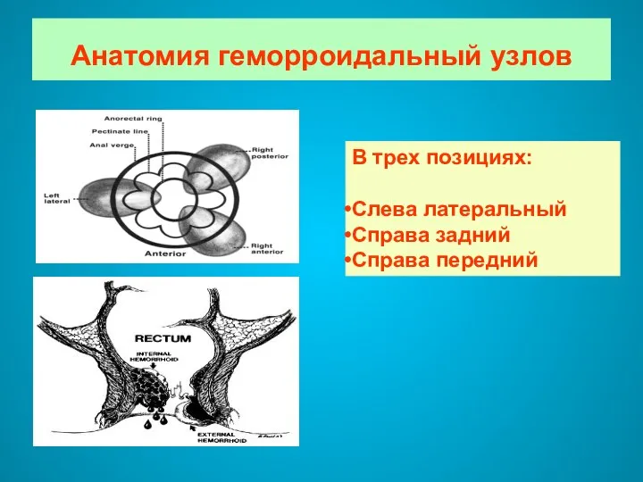 Анатомия геморроидальный узлов В трех позициях: Слева латеральный Справа задний Справа передний