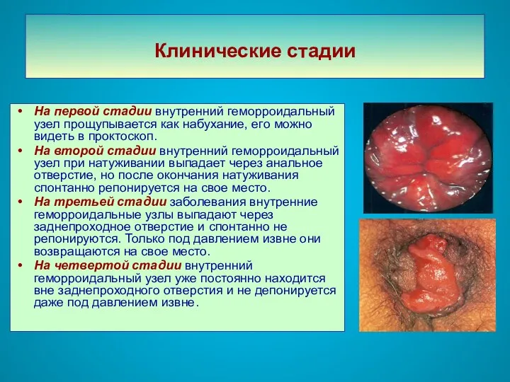 Клинические стадии На первой стадии внутренний геморроидальный узел прощупывается как набухание,