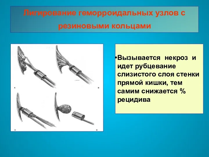 Лигирование геморроидальных узлов с резиновыми кольцами Вызывается некроз и идет рубцевание