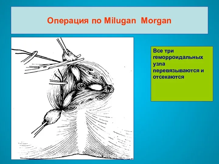 Операция по Milugan Morgan Все три геморроидальных узла перевязываются и отсекаются