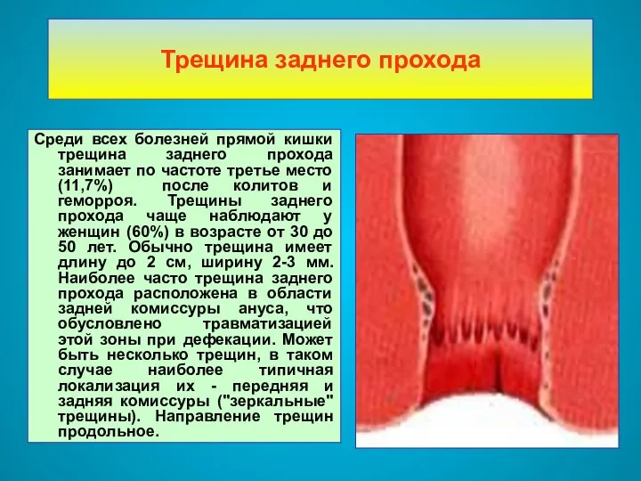 Трещина заднего прохода Среди всех болезней прямой кишки трещина заднего прохода