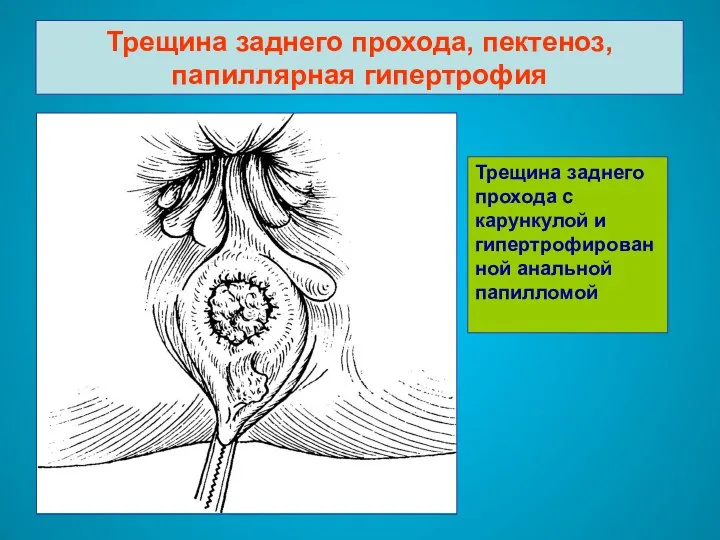 Трещина заднего прохода, пектеноз, папиллярная гипертрофия Трещина заднего прохода с карункулой и гипертрофированной анальной папилломой