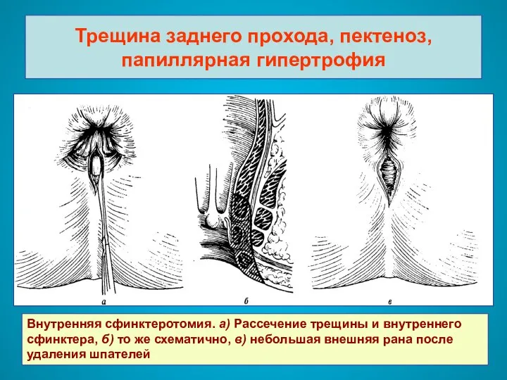 Трещина заднего прохода, пектеноз, папиллярная гипертрофия Внутренняя сфинктеротомия. а) Рассечение трещины