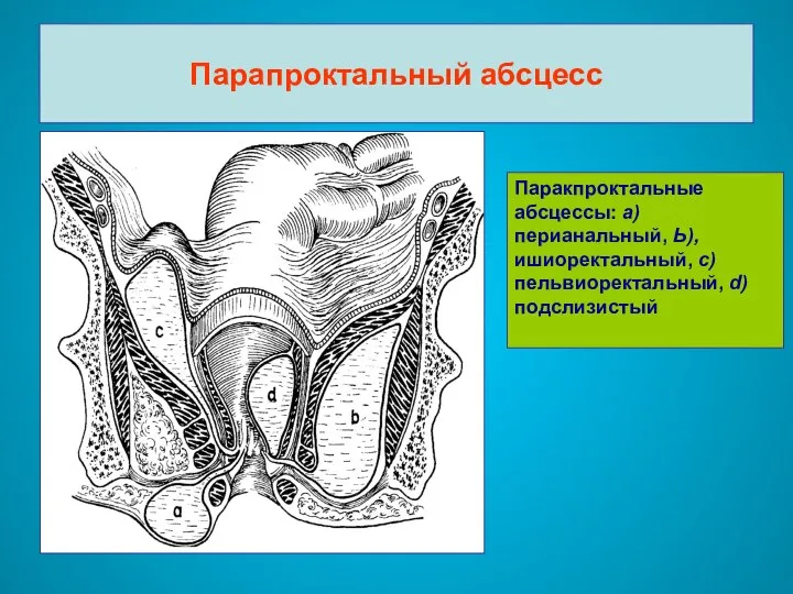 Парапроктальный абсцесс Паракпроктальные абсцессы: а) перианальный, Ь), ишиоректальный, с) пельвиоректальный, d) подслизистый