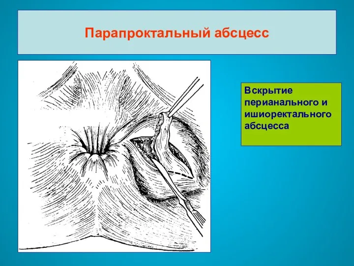 Парапроктальный абсцесс Вскрытие перианального и ишиоректального абсцесса