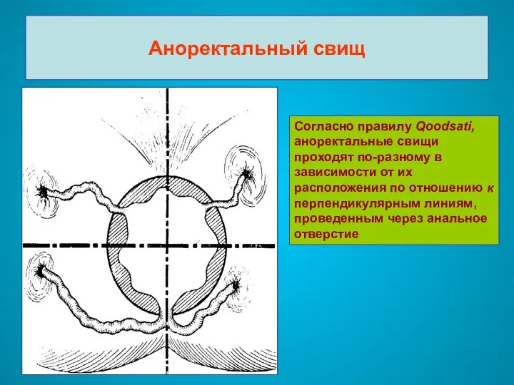 Аноректальный свищ Согласно правилу Qoodsati, аноректальные свищи проходят по-разному в зависимости