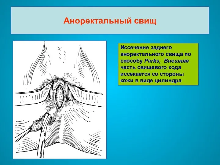 Аноректальный свищ Иссечение заднего аноректального свища по способу Parks, Внешняя часть