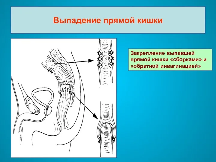 Выпадение прямой кишки Закрепление выпавшей прямой кишки «сборками» и «обратной инвагинацией»