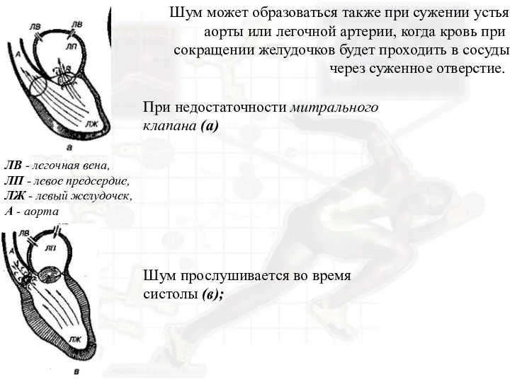 ЛВ - легочная вена, ЛП - левое предсердие, ЛЖ - левый