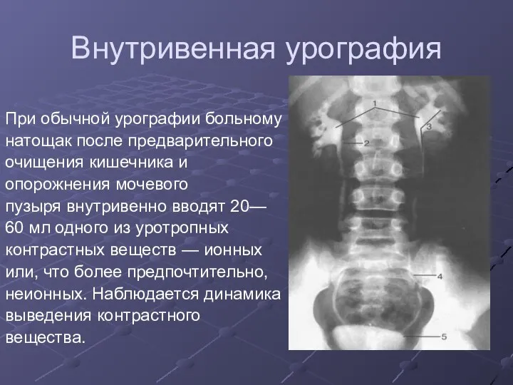 Внутривенная урография При обычной урографии больному натощак после предварительного очищения кишечника