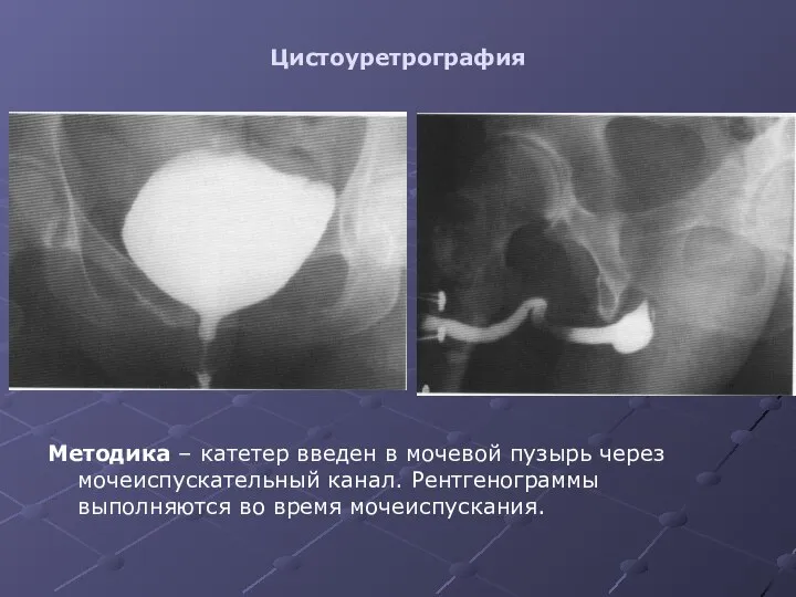 Цистоуретрография Методика – катетер введен в мочевой пузырь через мочеиспускательный канал. Рентгенограммы выполняются во время мочеиспускания.