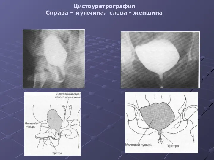 Цистоуретрография Справа – мужчина, слева - женщина