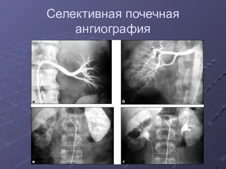 Селективная почечная ангиография