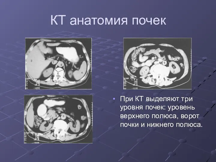 КТ анатомия почек При КТ выделяют три уровня почек: уровень верхнего