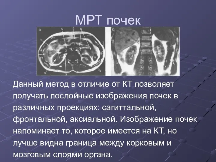 МРТ почек Данный метод в отличие от КТ позволяет получать послойные