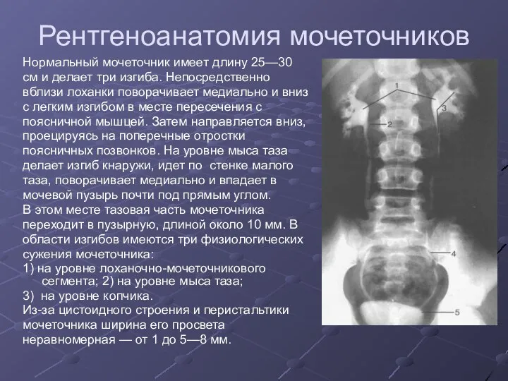 Рентгеноанатомия мочеточников Нормальный мочеточник имеет длину 25—30 см и делает три