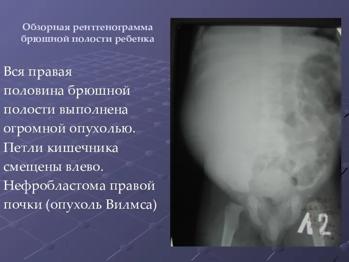 Обзорная рентгенограмма брюшной полости ребенка Вся правая половина брюшной полости выполнена