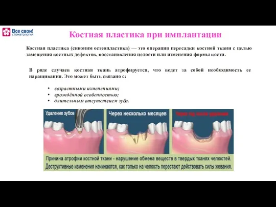 Костная пластика при имплантации возрастными изменениями; врождённой особенностью; длительным отсутствием зуба.