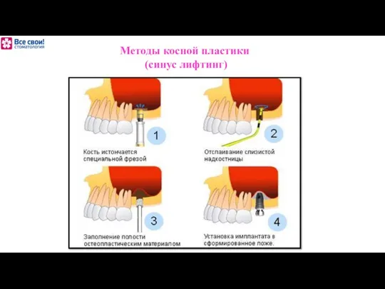 Методы косной пластики (синус лифтинг)