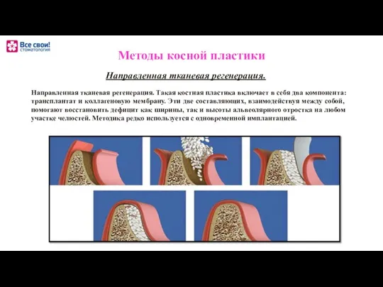 Направленная тканевая регенерация. Такая костная пластика включает в себя два компонента: