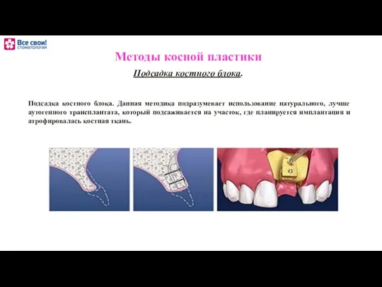 Подсадка костного блока. Данная методика подразумевает использование натурального, лучше аутогенного трансплантата,