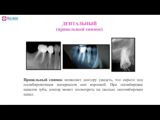 ДЕНТАЛЬНЫЙ (прицельный снимок) Прицельный снимок позволяет доктору увидеть, что скрыто под