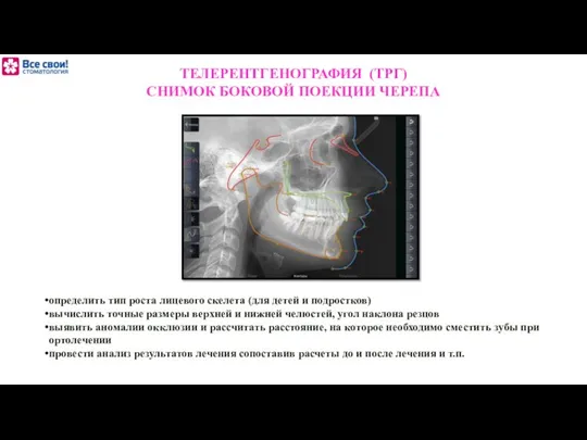 ТЕЛЕРЕНТГЕНОГРАФИЯ (ТРГ) СНИМОК БОКОВОЙ ПОЕКЦИИ ЧЕРЕПА определить тип роста лицевого скелета