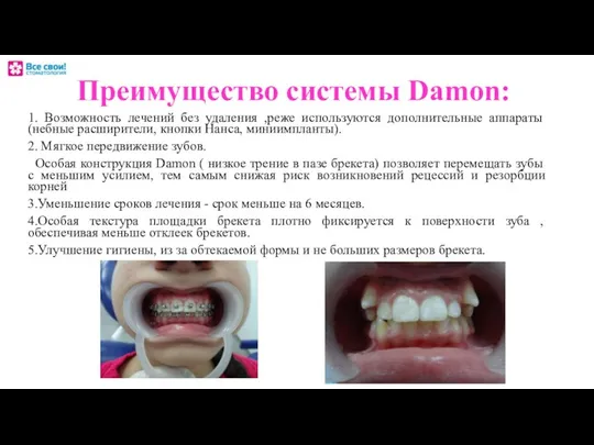 Преимущество системы Damon: 1. Возможность лечений без удаления ,реже используются дополнительные