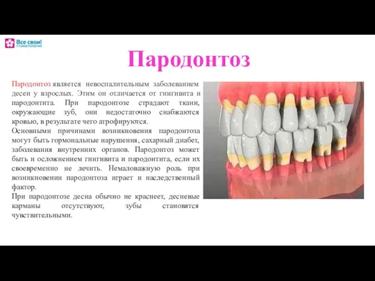 Пародонтоз Пародонтоз является невоспалительным заболеванием десен у взрослых. Этим он отличается