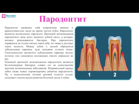 Пародонтит Пародонтит проявляет себя неприятным запахом и кровоточивостью десен во время