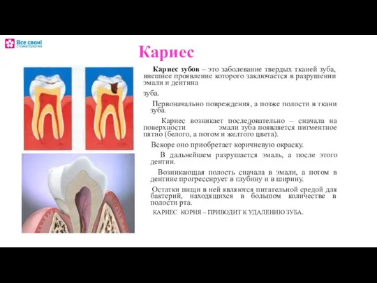 Кариес Кариес зубов – это заболевание твердых тканей зуба, внешнее проявление