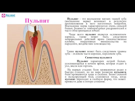 Пульпит Пульпит - это воспаление мягких тканей зуба (воспаление нерва) возникает