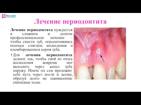 Лечение периодонтита Лечение периодонтита нуждается в сложном и долгом профессиональном лечении