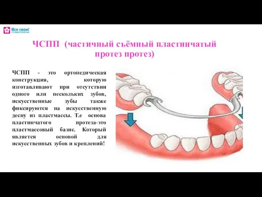 ЧСПП (частичный съёмный пластинчатый протез протез) ЧСПП - это ортопедическая конструкция,