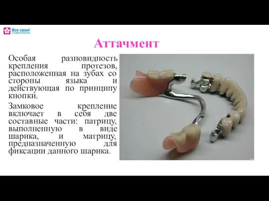 Аттачмент Особая разновидность крепления протезов, расположенная на зубах со стороны языка