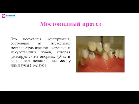 Мостовидный протез Это несъемная конструкция, состоящая из нескольких металлокерамических коронок и