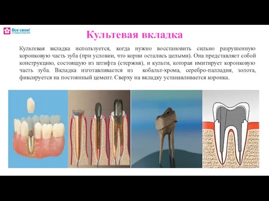 Культевая вкладка Культевая вкладка используется, когда нужно восстановить сильно разрушенную коронковую