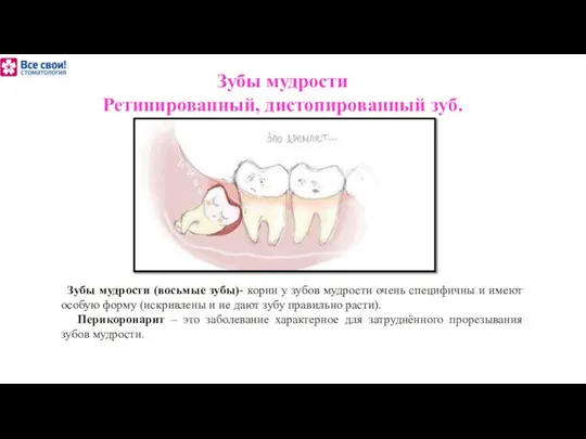 Зубы мудрости Ретинированный, дистопированный зуб. Зубы мудрости (восьмые зубы)- корни у