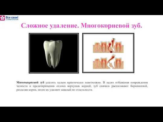 Сложное удаление. Многокорневой зуб. Многокорневой зуб удалить целым практически невозможно. В