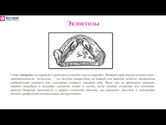 Слово «экзостоз» (в переводе с греческого) означает «кость снаружи». Название практически