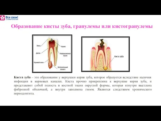 Образование кисты зуба, гранулемы или кистогранулемы Киста зуба – это образование