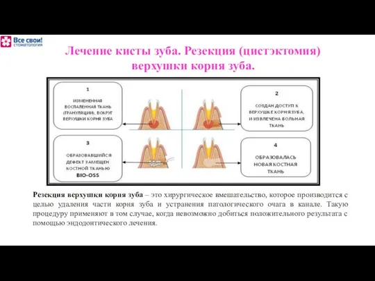 Лечение кисты зуба. Резекция (цистэктомия) верхушки корня зуба. Резекция верхушки корня