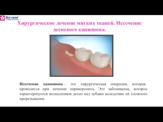 Хирургическое лечение мягких тканей. Иссечение десневого капюшона. Иссечение капюшона – это