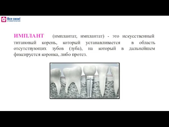 ИМПЛАНТ (имплантат, имплантат) - это искусственный титановый корень, который устанавливается в